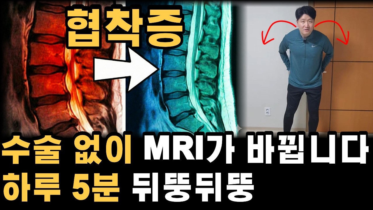 허리 협착증으로 10분도 못 서있던 내 허리, '걷기' 멈추고 '이것' 해서 살았습니다.
