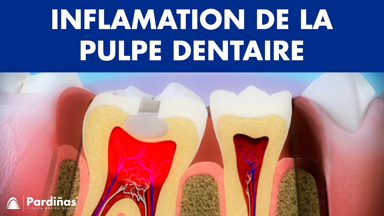 Pulpite &ndash; Inflamation de la pulpe dentaire &copy;