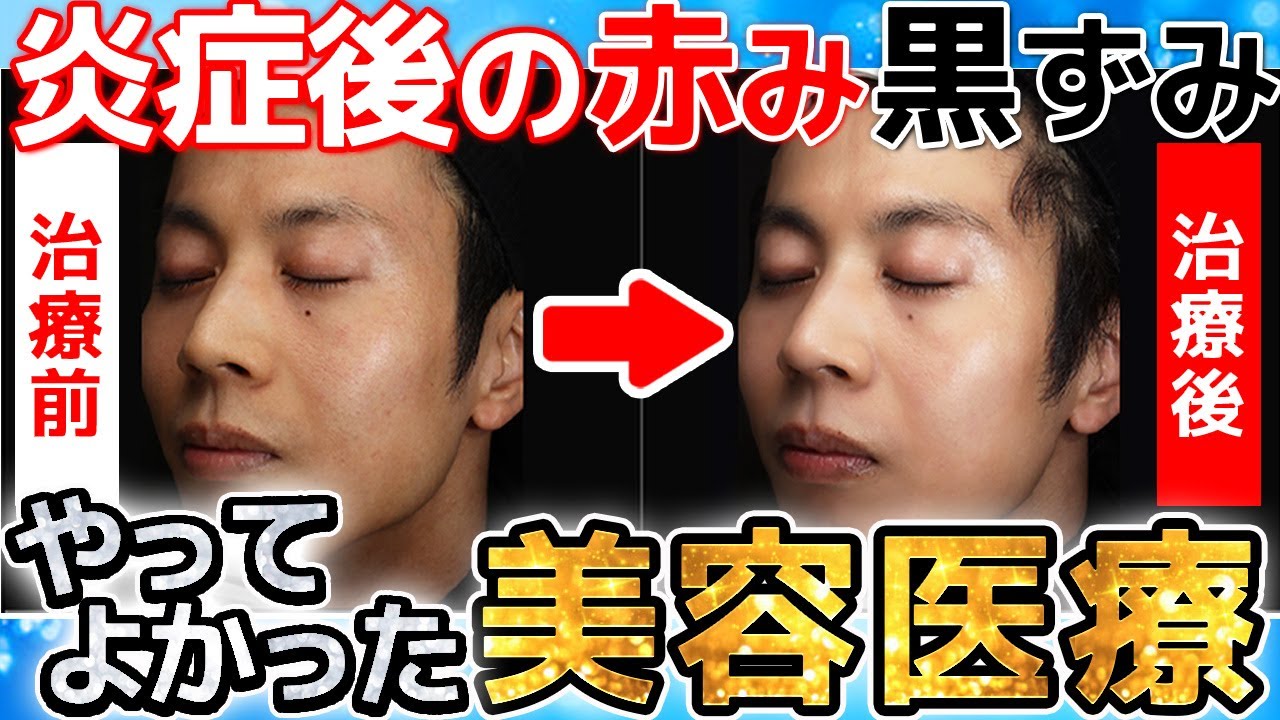 【効果やいかに…！】アトピーの赤み・色素沈着はIPLとpicoレーザー治療でどこまで解決する？