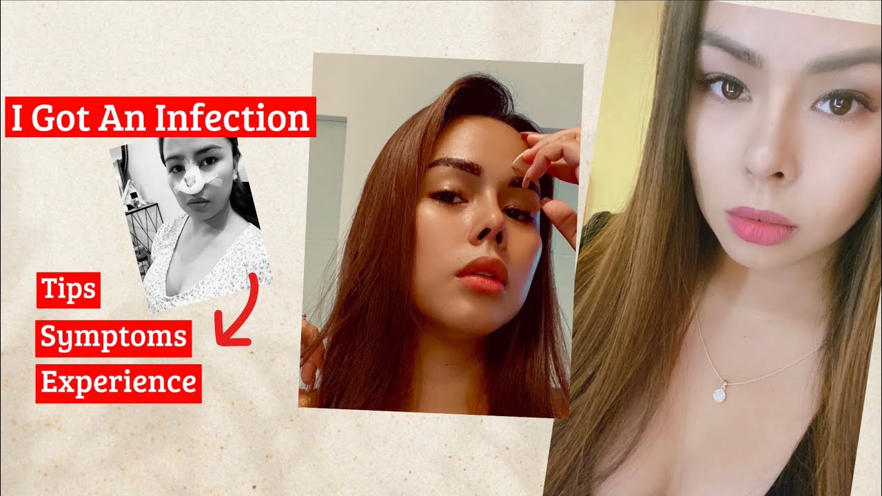 I GOT AN INFECTION | NOSE JOB INFECTION AFTER 5 MONTHS