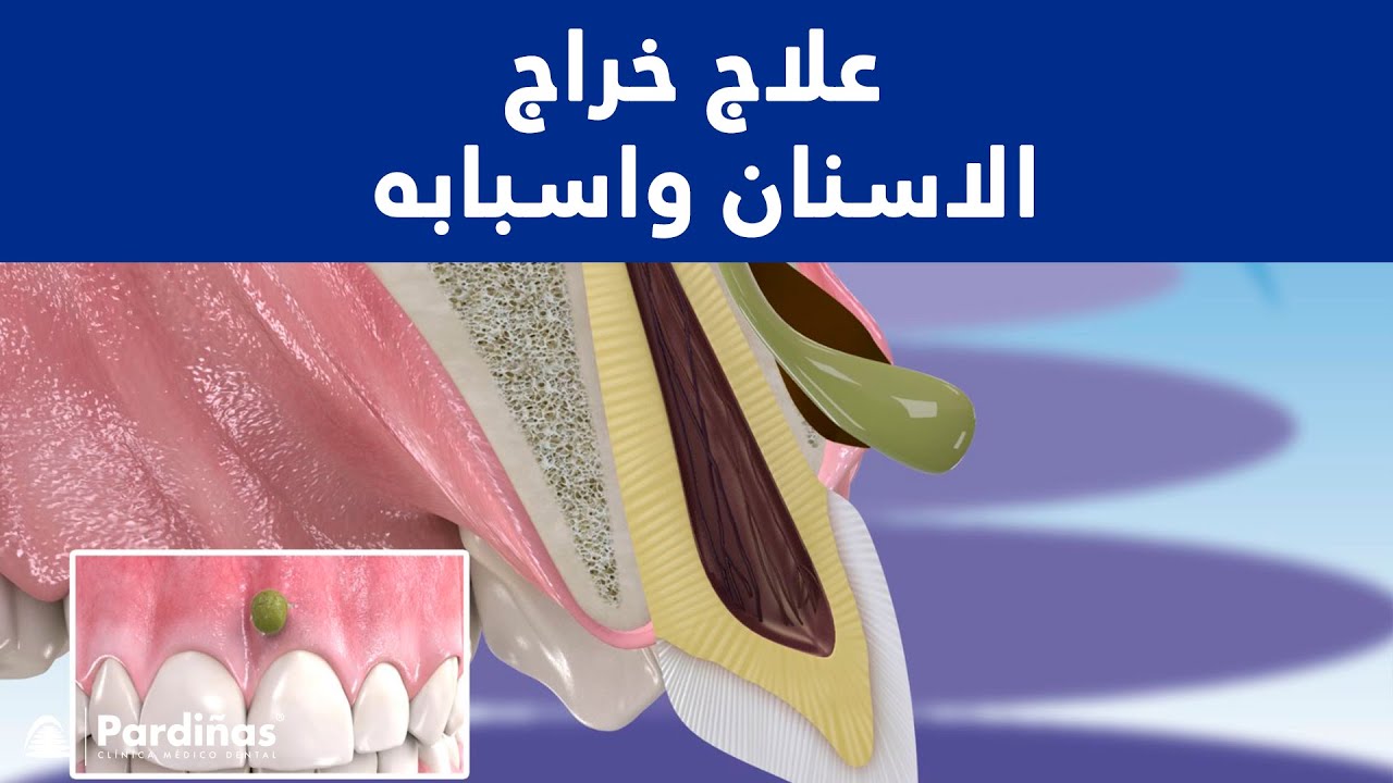 © علاج خراج الاسنان واسبابه