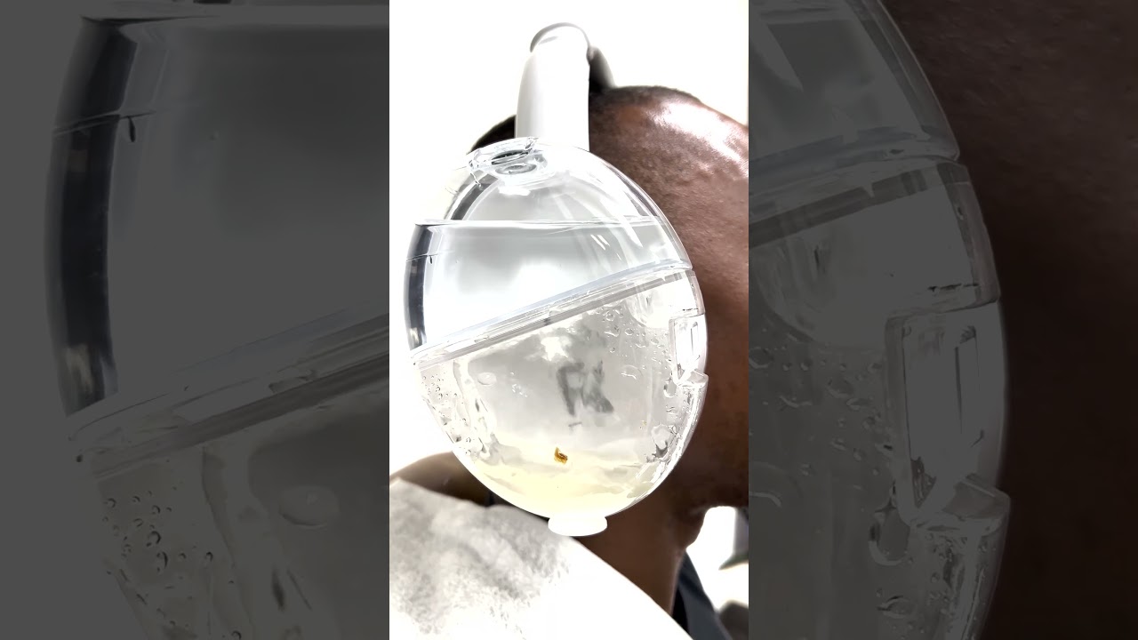 Are you tired of earwax buildup? Try a smarter solution: OtoSet