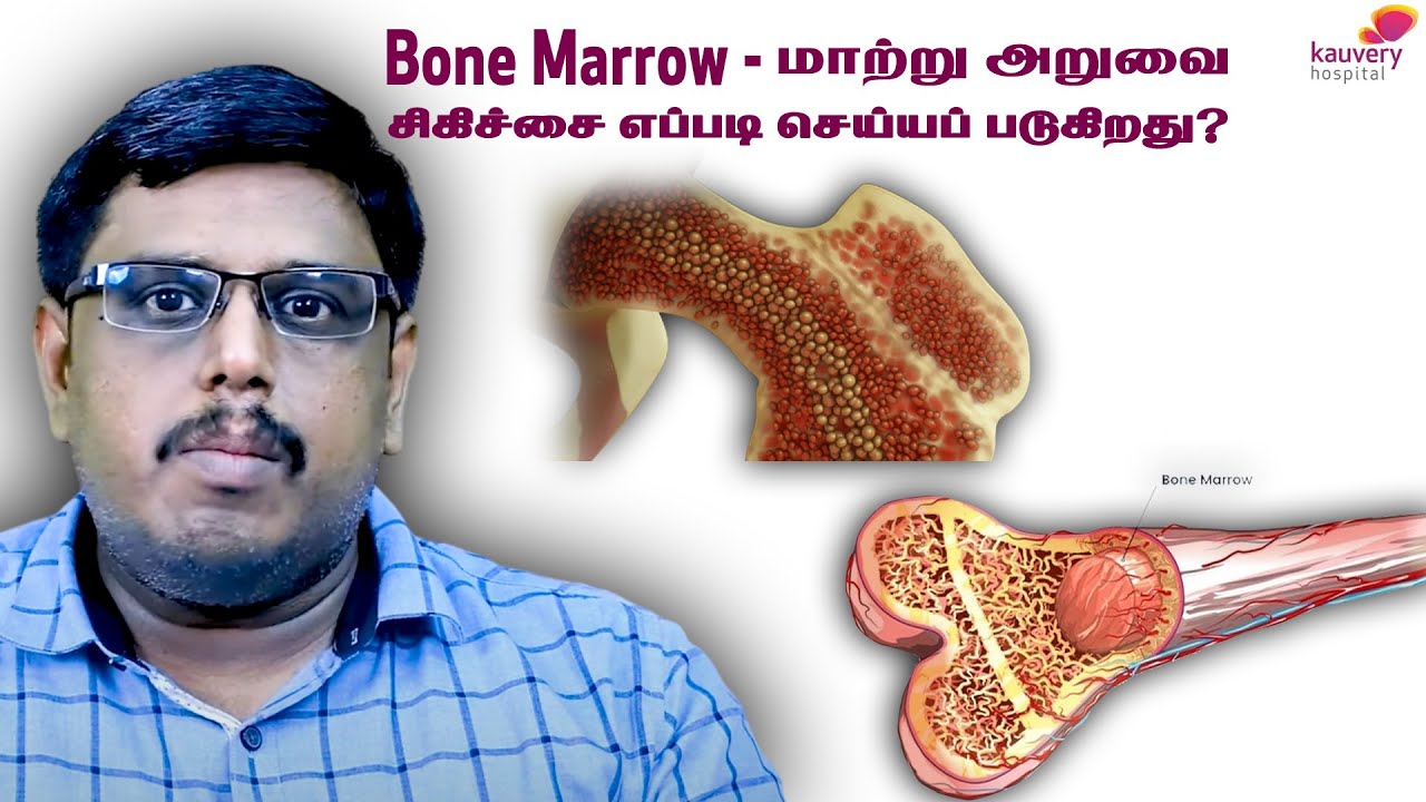 Bone Marrow Transplant Procedure | எலும்பு மஜ்ஜை மாற்று அறுவை சிகிச்சை எப்படி செய்யப் படுகிறது?