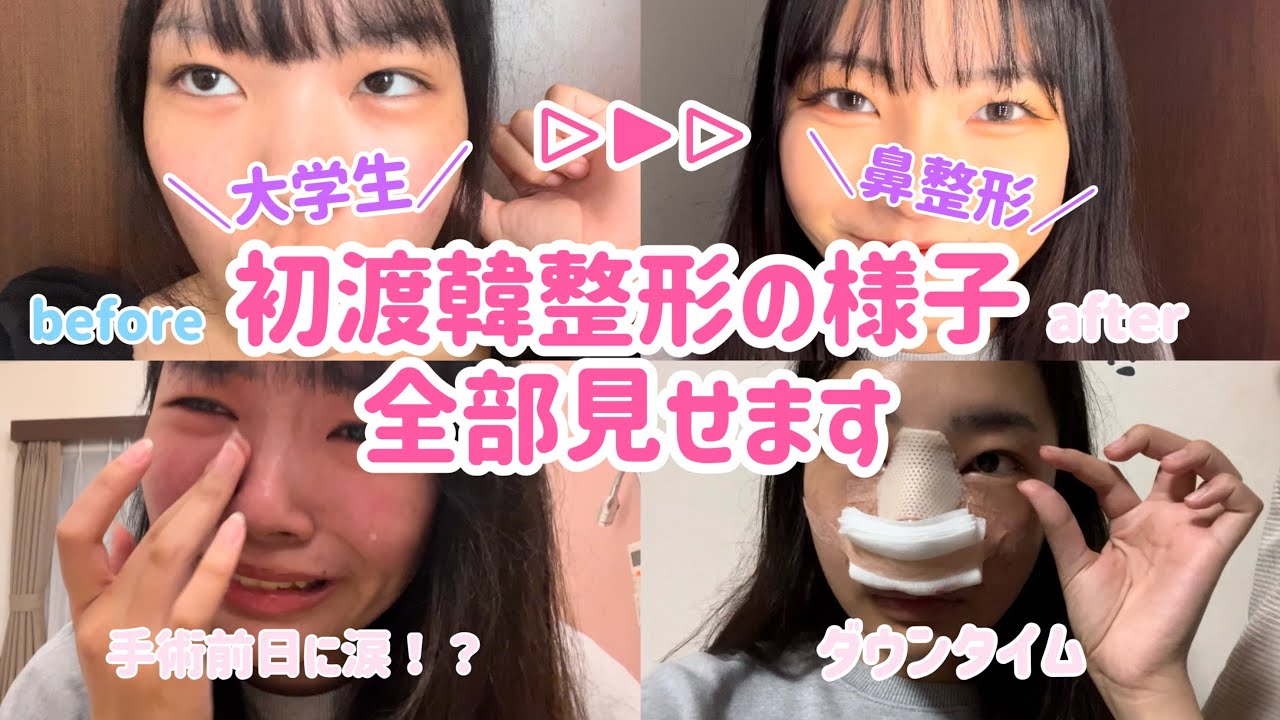 【密着動画】私の初渡韓整形の様子全部見せます！鼻フル整形1か月前~ダウンタイム1週間後まで載ってます💖（危険な日程で行動してるので真似して欲しくはないです🙇‍♀️)【鼻フル整形Vlog】【女子大学生】