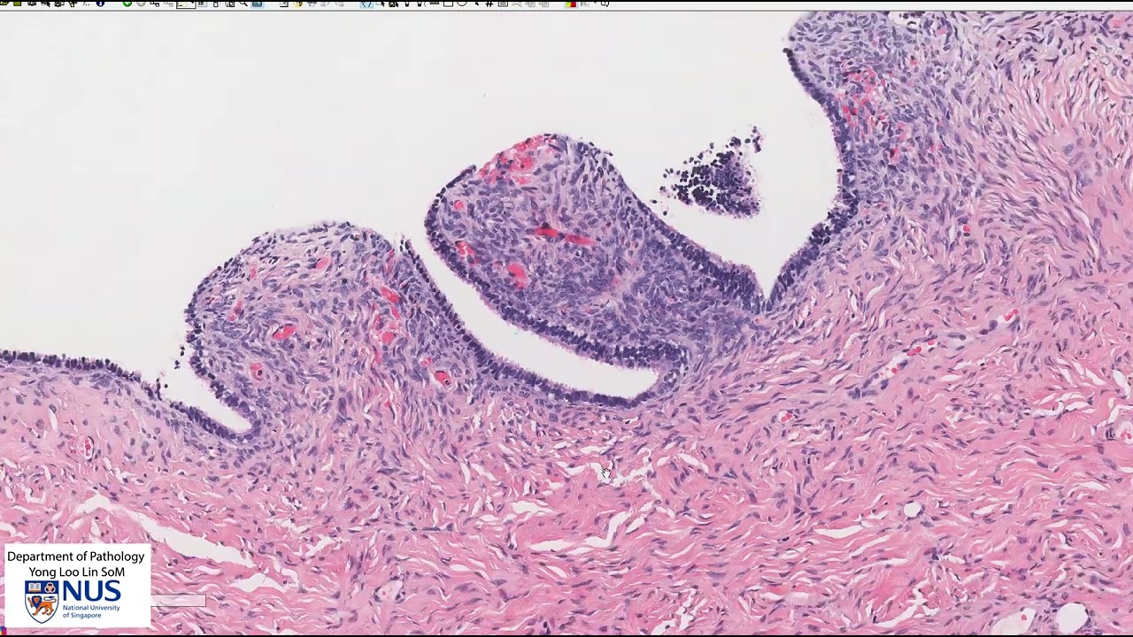 Ovary: Serous cystadenoma Microscopy - Talking slide