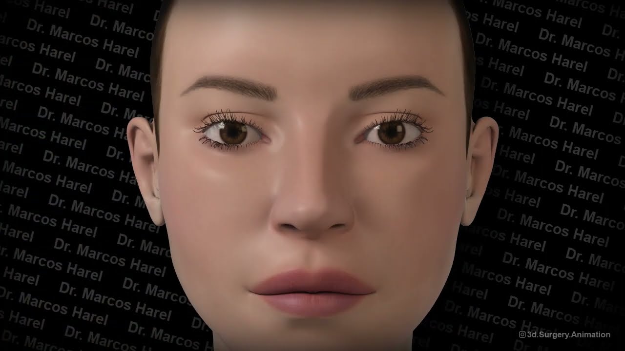 Dr. Marcos Harel - Septal Extension Graft in Non Delivery Closed Rhinoplasty (Animation)