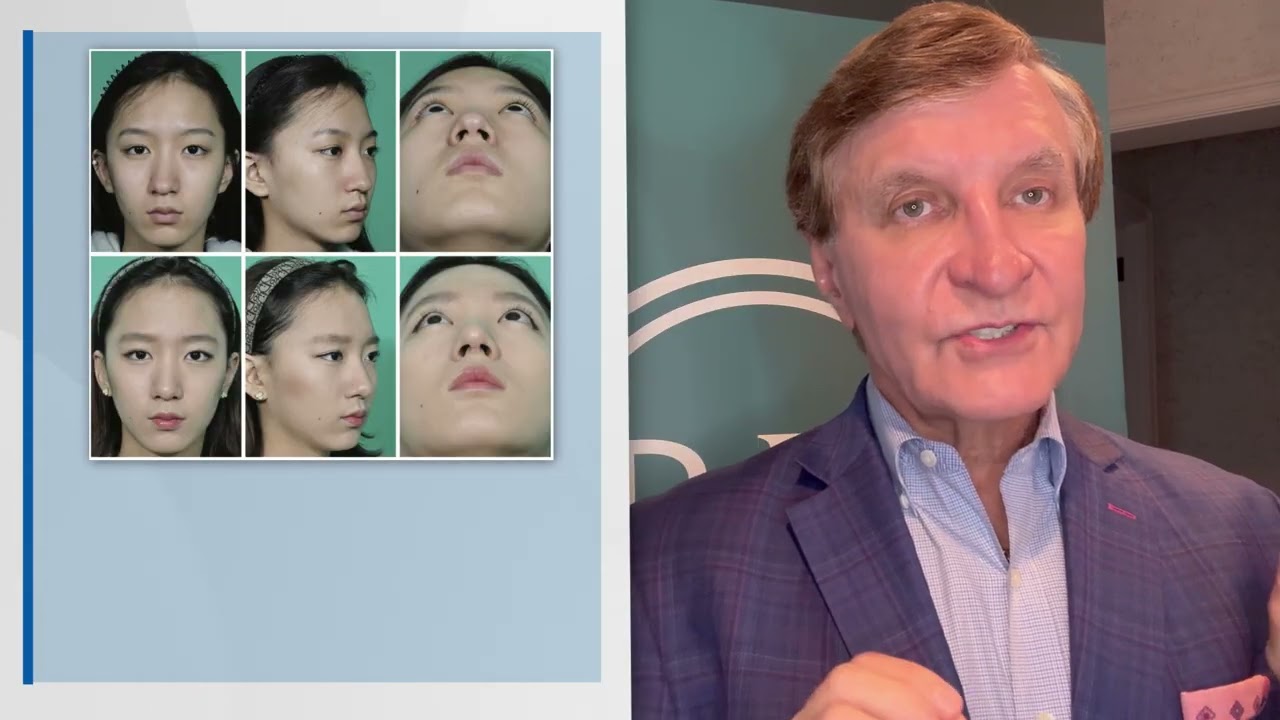 Results of Rhinoplasty Using a Cartilage Support Graft by Rod J. Rohrich, MD
