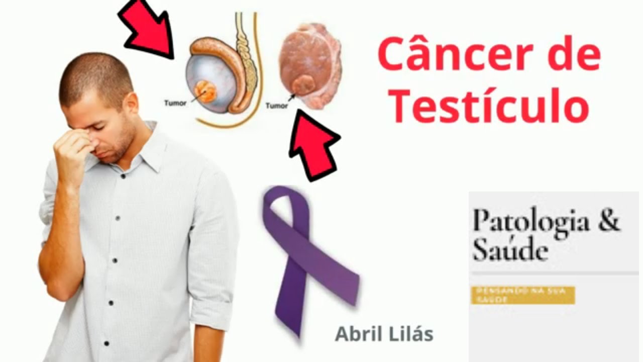 Câncer de testículo: O que é e quais os sintomas?
