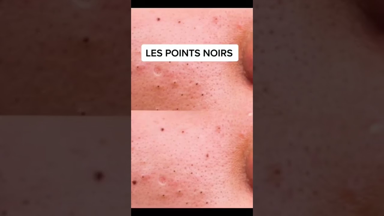 Comment lutter contre les points noirs ? 🧖🏼&zwj;♀️