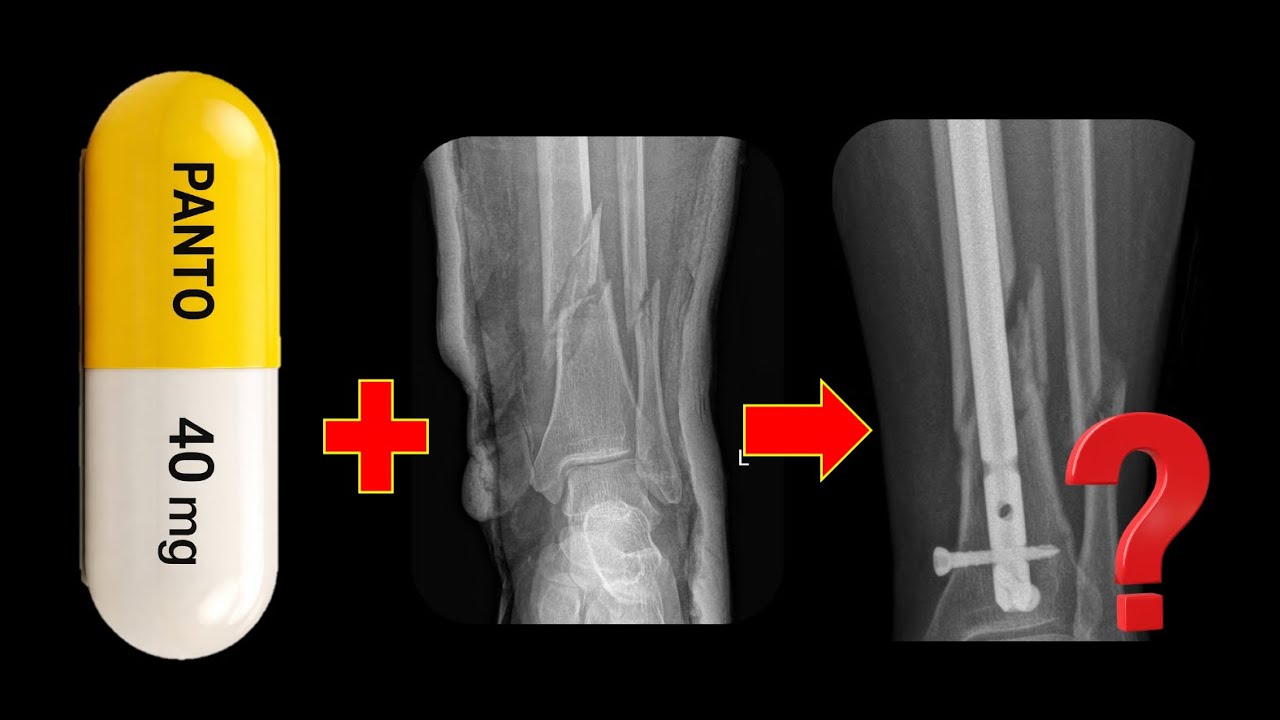 Do Proton Pump Inhibitors (PPIs) Impact Fracture Healing