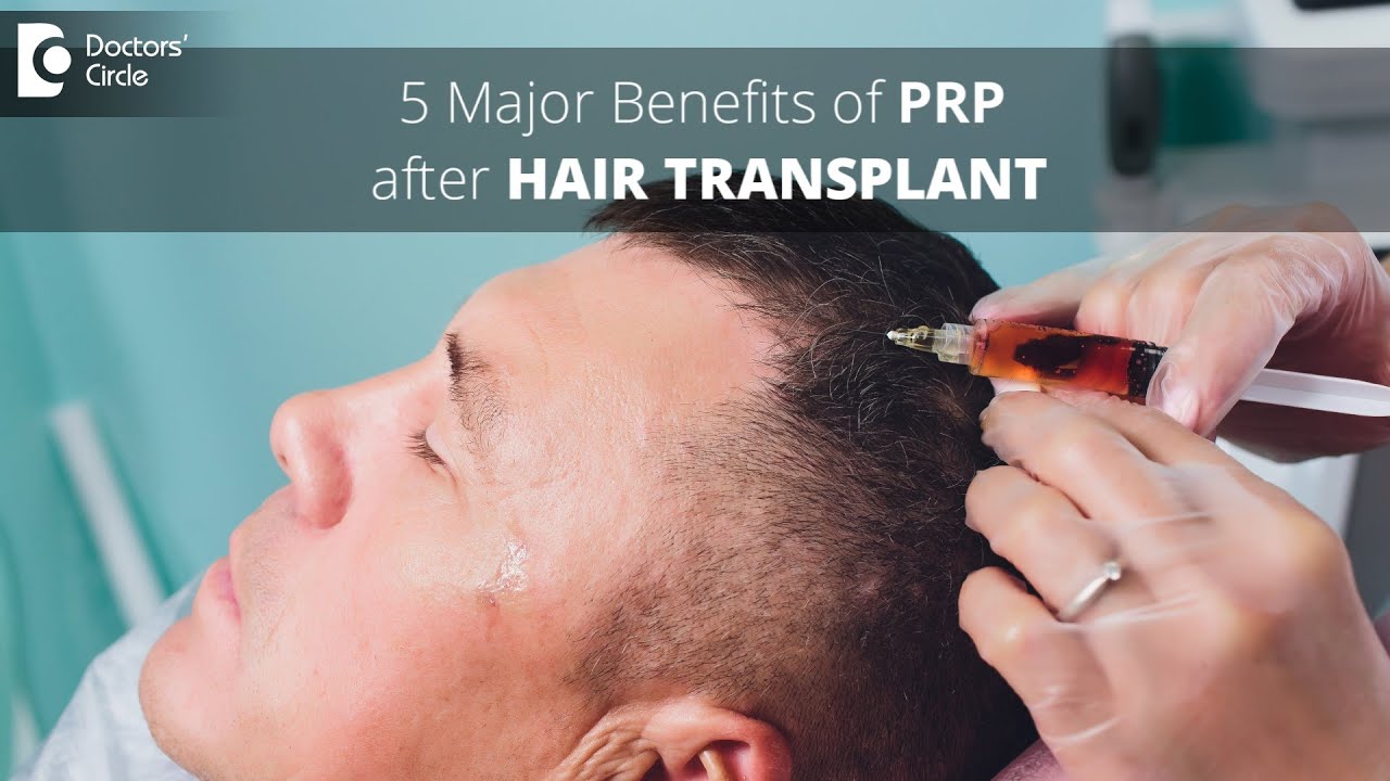 5 Benefits of PRP after Hair Transplant | Is PRP useful ? - Dr. Deepak P Devakar | Doctors' Circle