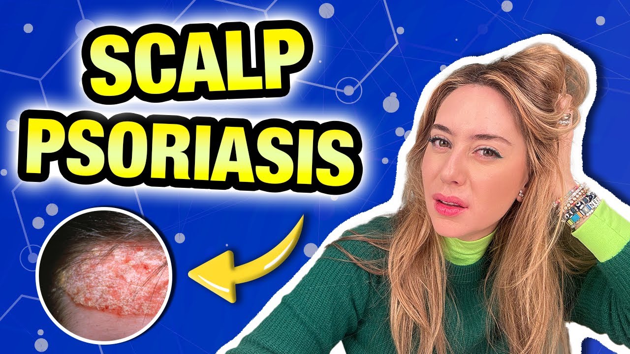Scalp Psoriasis: Top Tips & Derm-Approved Treatments for Dry, Flaky Scalp! | Dr. Shereene Idriss
