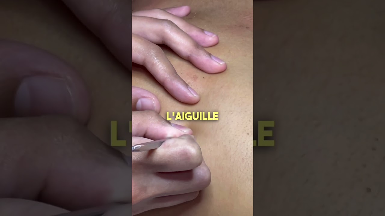 J'ai essay&eacute; un traitement contre l'acn&eacute; du dos avec des lumi&egrave;res rouges! #shorts