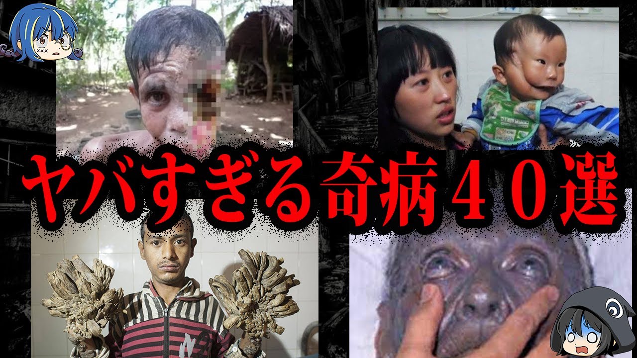 【ゆっくり解説】閲覧注意。世界のヤバすぎる奇病４０選【総集編】