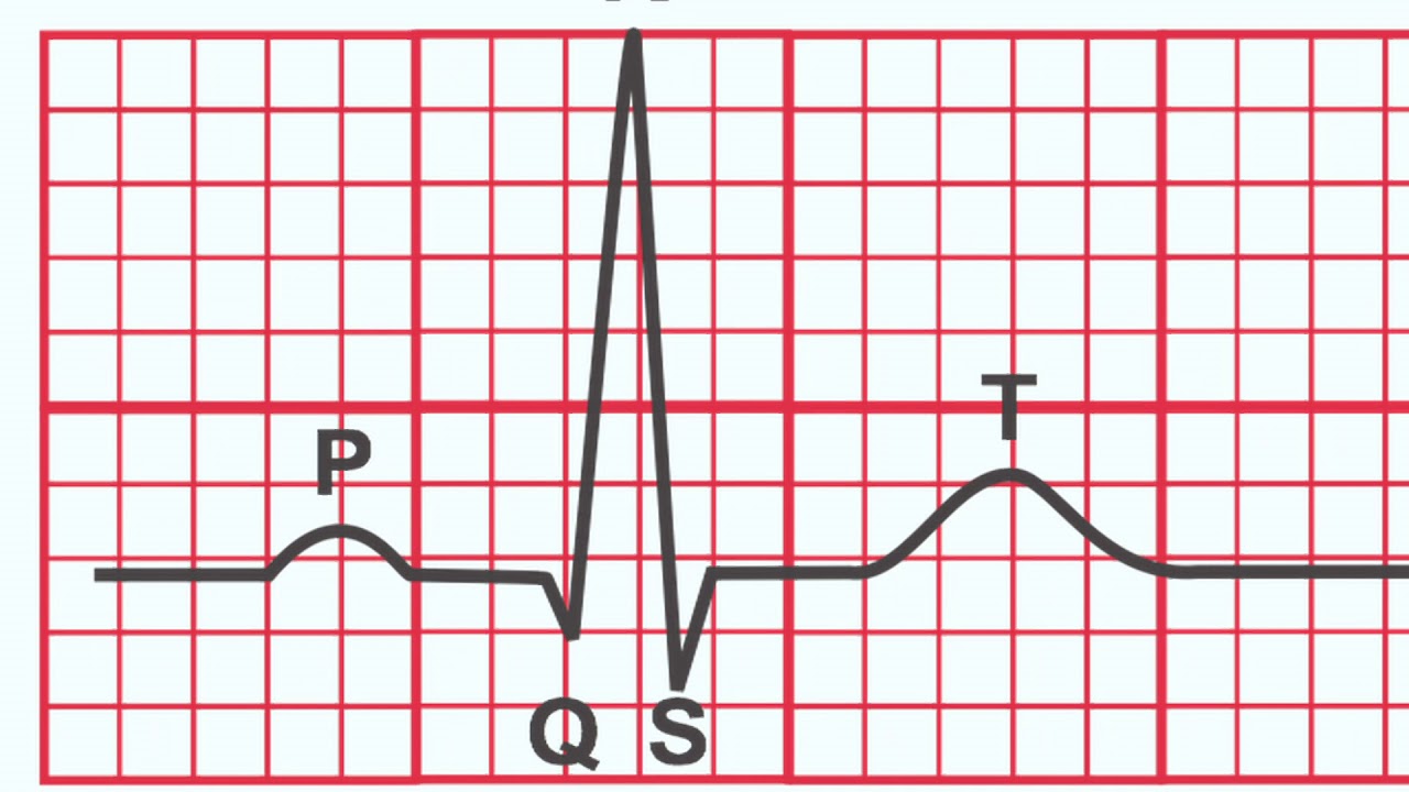 Normal EKG vs. Heart Attack