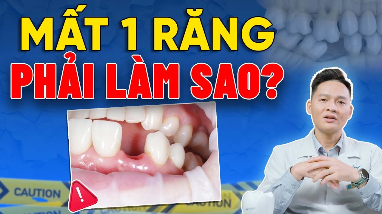 HẬU QUẢ CỦA VIỆC MẤT 1 RĂNG VÀ GIẢI PHÁP TRỒNG RĂNG IMPLANT ĐƠN LẺ