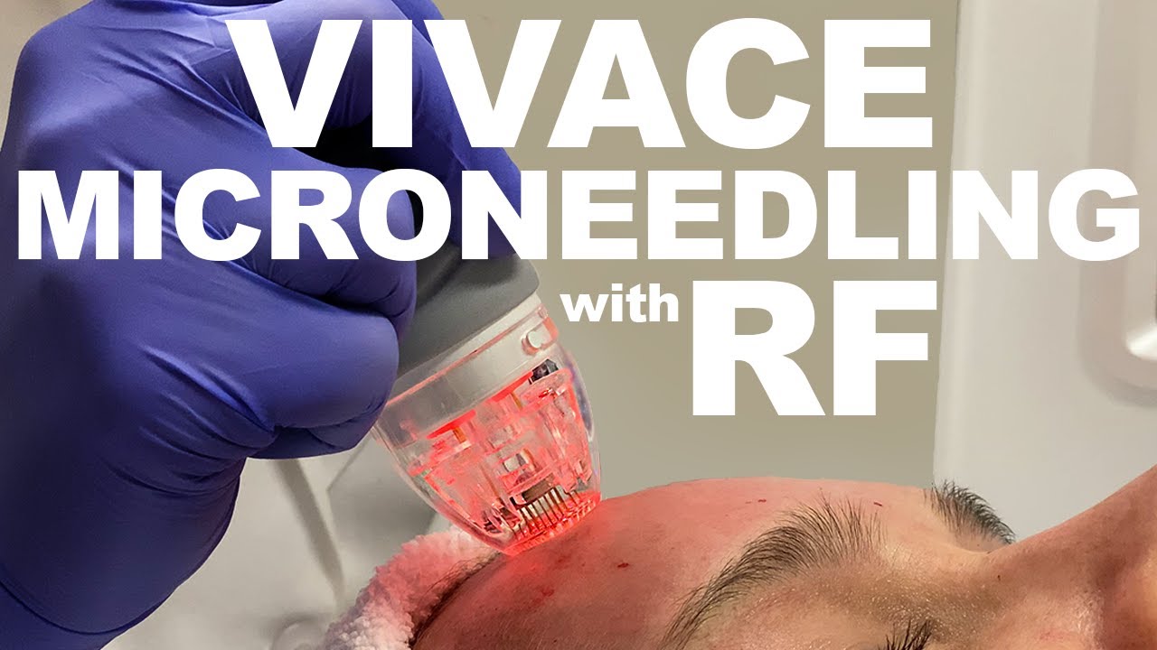 Vivace: Microneedling with Radio Frequency | West End Plastic Surgery