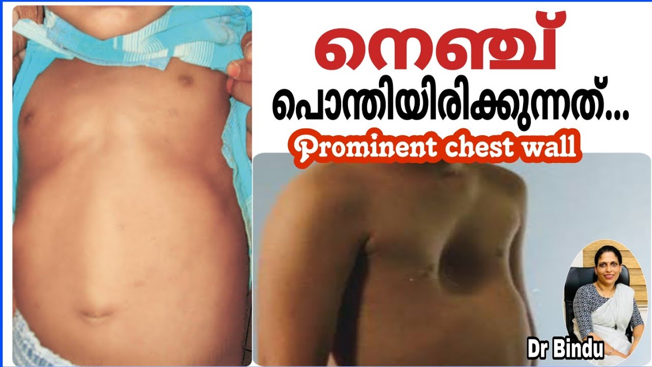 കൂർത്തിരിക്കുന്ന/താഴ്ന്നിരിക്കുന്ന നെഞ്ച്/Prominent chest wall in children/Dr Bindu childhealth tips