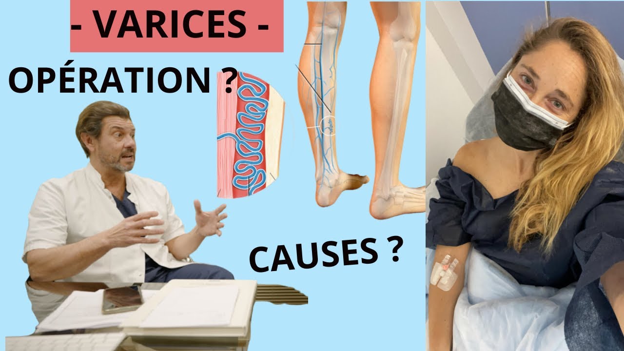 Tout sur les VARICES ! Causes, Opération, post-op, sport...