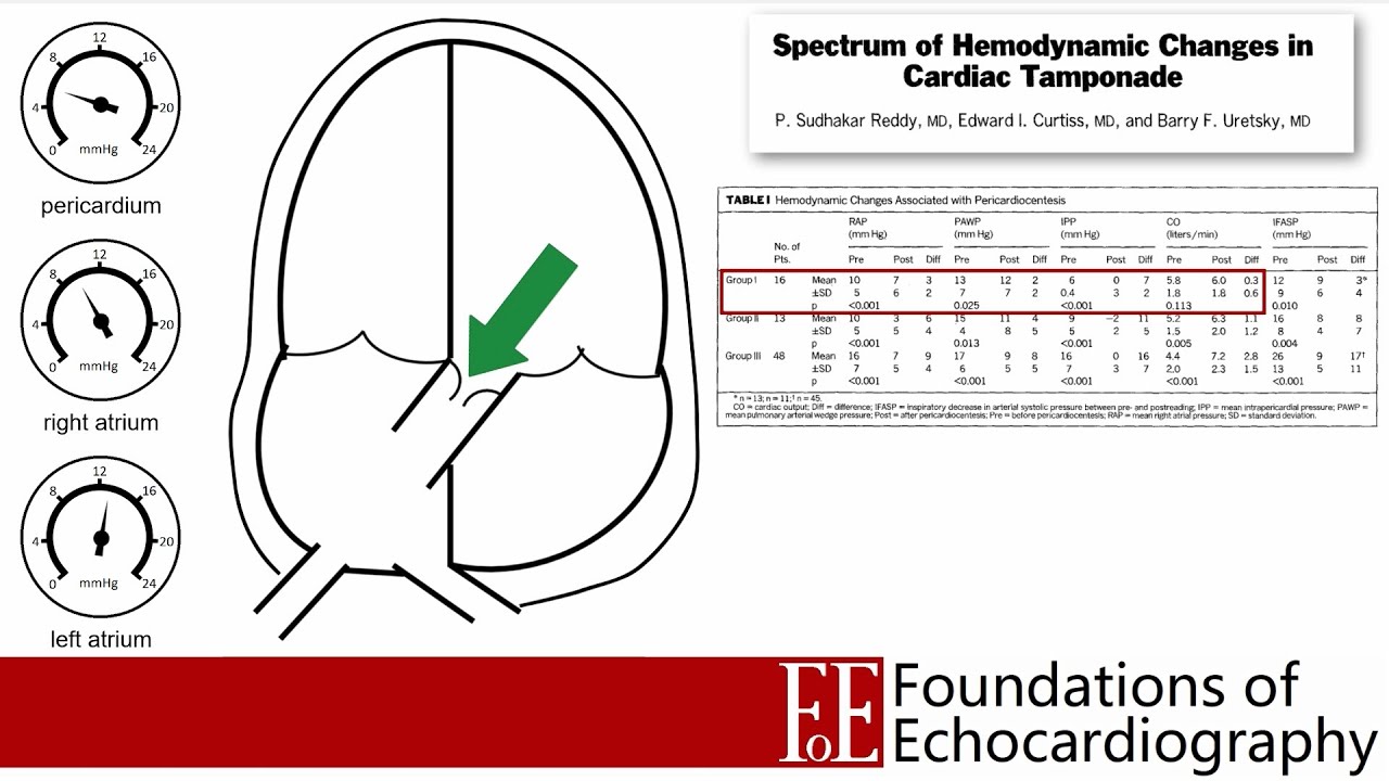 Level 1 Video Lecture: Pericardial Effusions and Cardiac Tamponade