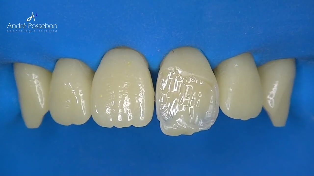 🎯 Dica #25 - Como posicionar corretamente a dentina em classe IV.