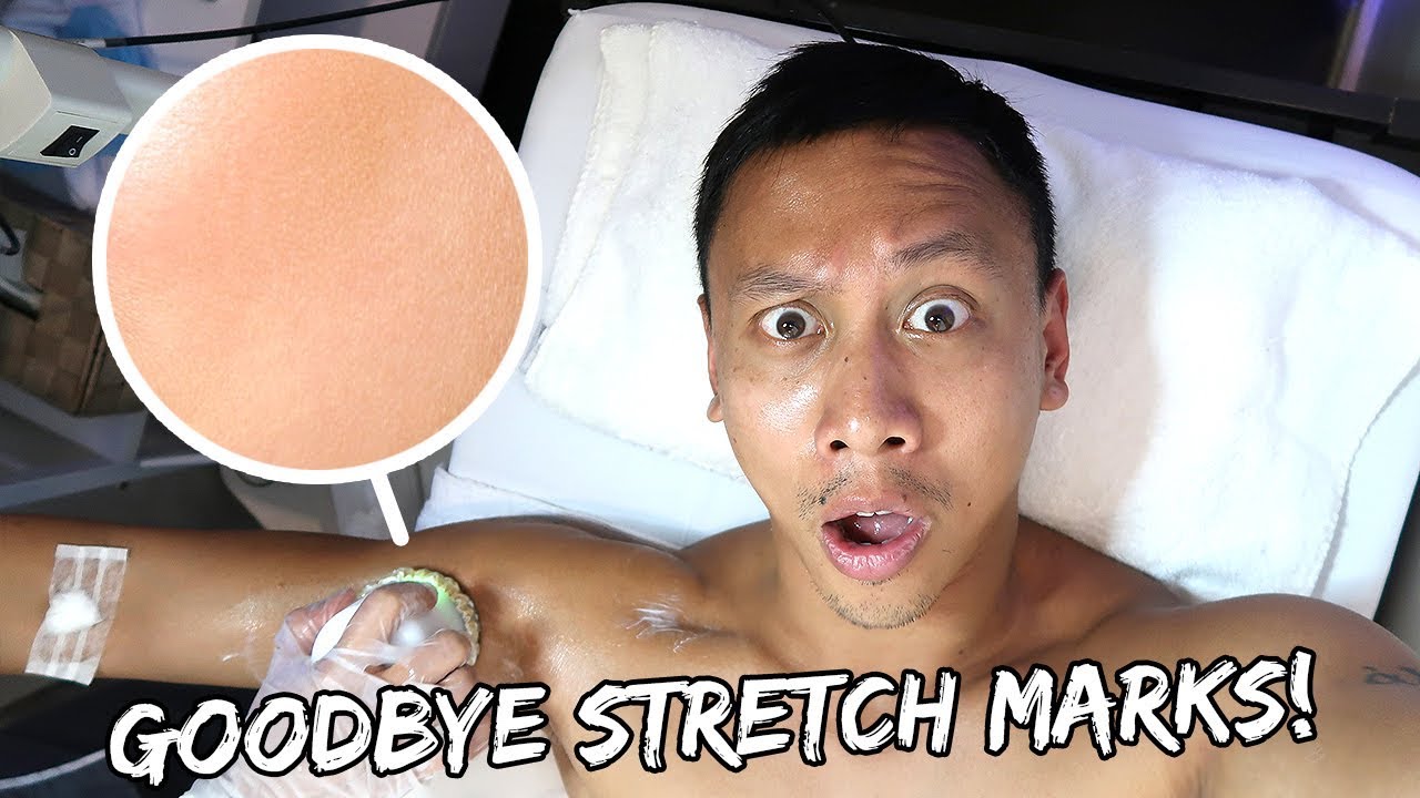 Getting Rid of Stretch Marks! | Vlog #492