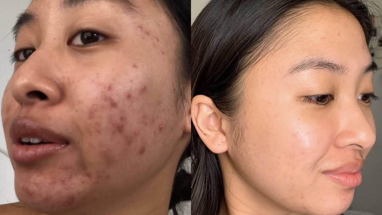 I tried differin gel for a whole year || Aiko Sipe