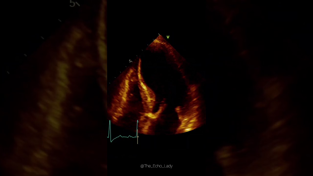 Can you guess the EF? 😐🫀✨ #cardiologia #echocardiogram #cardiology #HeartFailure