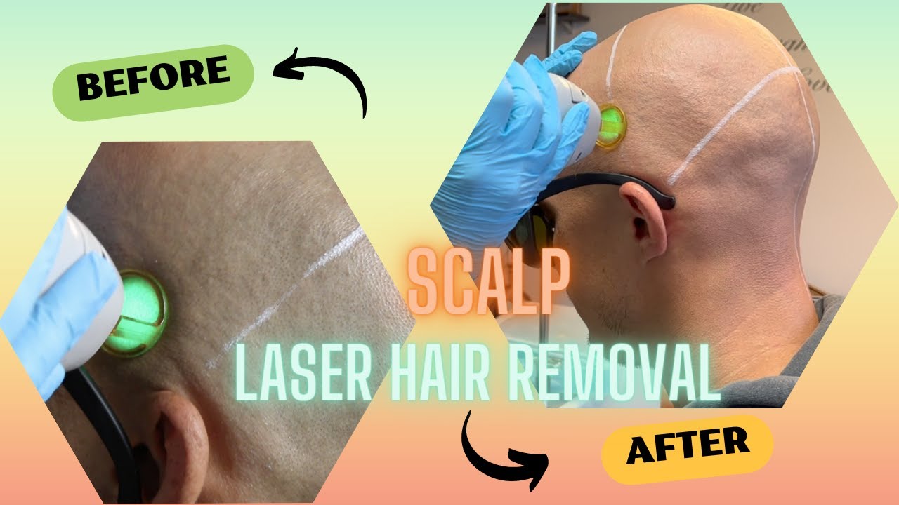 SPECTACULAR SCALP LASER HAIR REMOVAL RESULTS!!