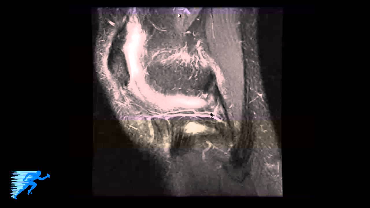 How to Read Knee MRI of MCL Injury | Complex Knee Surgeon | Knee Pain Diagnosis | Twin Cities, MN