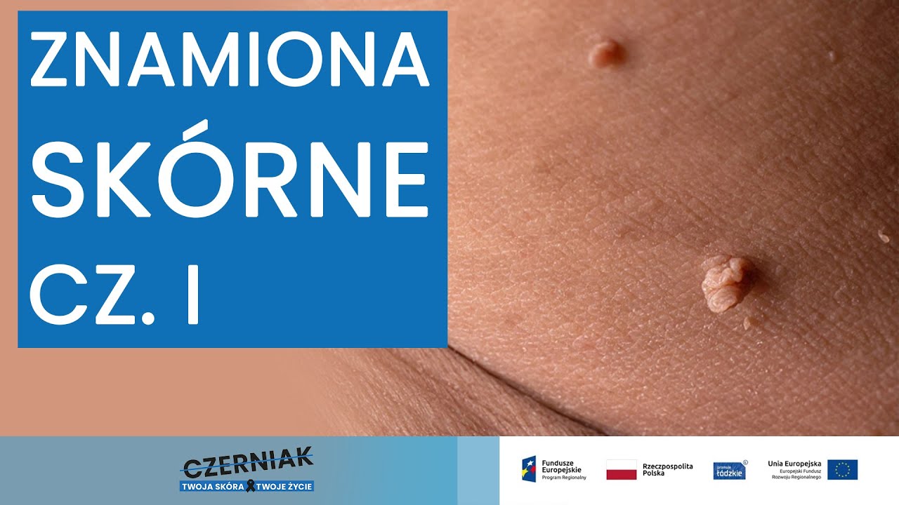 Znamiona skórne cz.  I - Prof. dr hab. n. med. Agnieszka Żebrowska