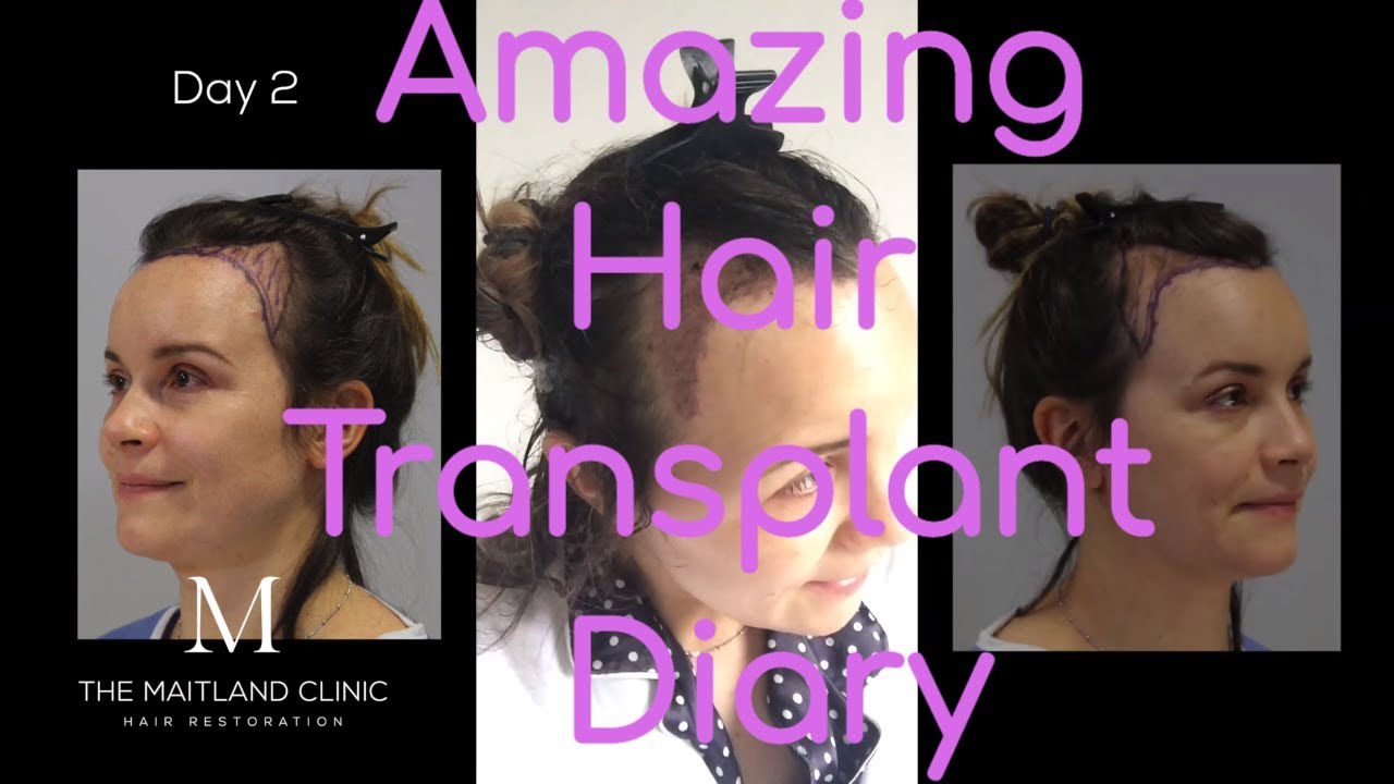 Female Hairline Lowering - Laura's Diary Day 1 to Day 6 and 14 Months
