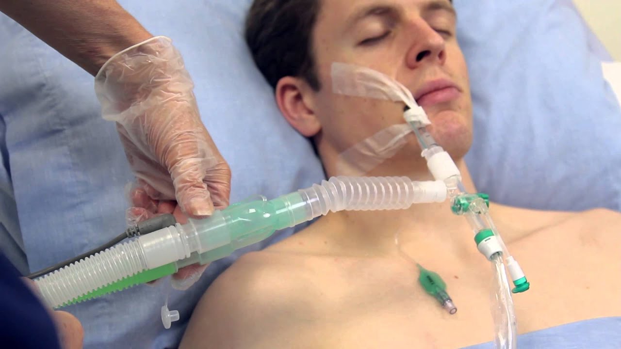Intersurgical TrachSeal sonda de aspiración cerrada