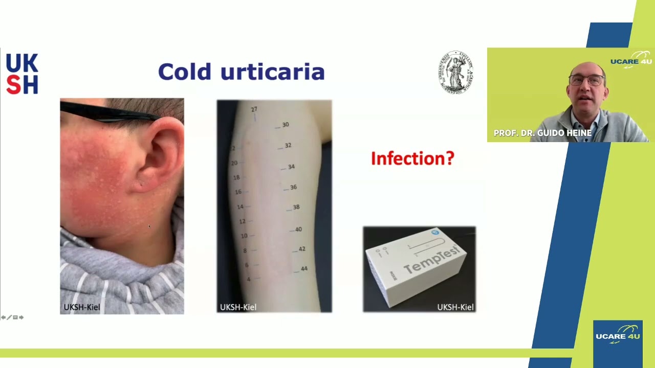 UCARE 4U Patient Webinar 12_Part 2: Pathophysiology of Urticaria
