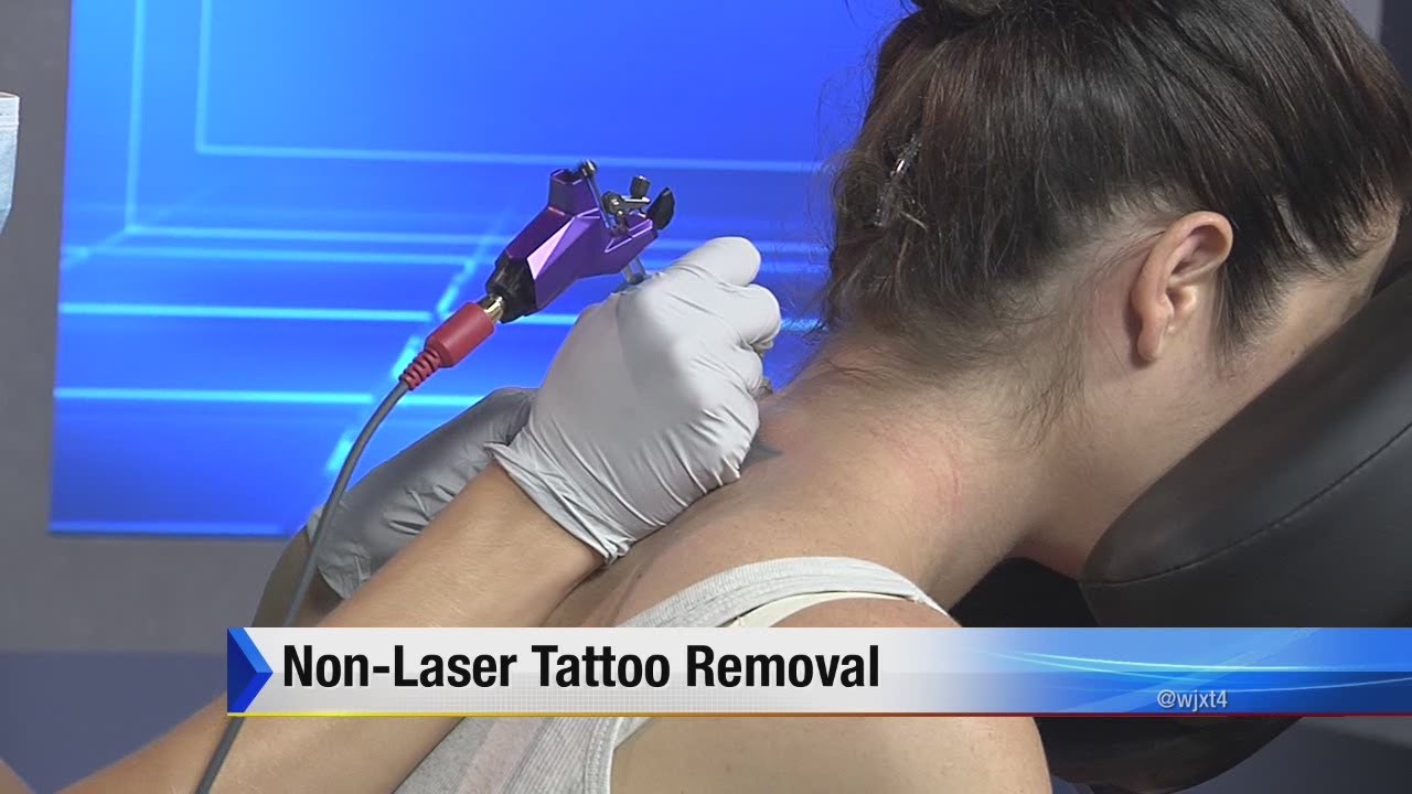 Non-laser tattoo removal