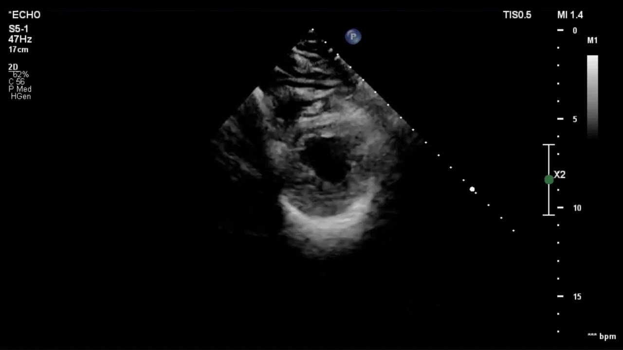 [Echo Case Review]Moderate to severe AR 중증도 대동맥판 역류