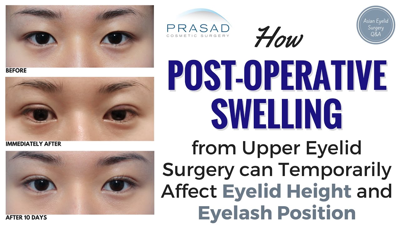 How Healing from Asian Eyelid Surgery Can Cause Temporary Changes in Eyelid and Eyelash Position