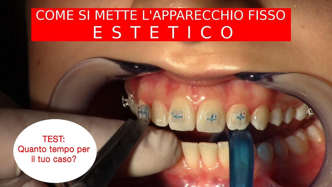 Come si mette l'apparecchio fisso estetico?