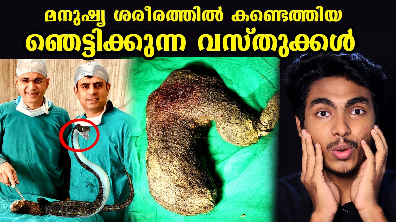 വയറിനകത്ത് പാമ്പ് മുതൽ ബോംമ്പ് വരെ | CRAZY THINGS FOUND INSIDE HUMAN BODY | MALAYALAM | AFWORLD