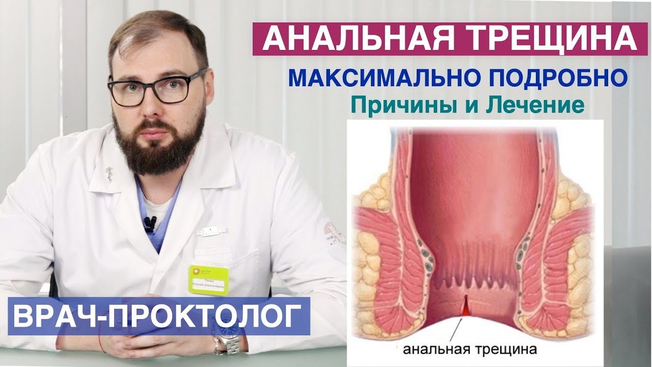 Анальная трещина - симптомы, причины, лечение, профилактика.