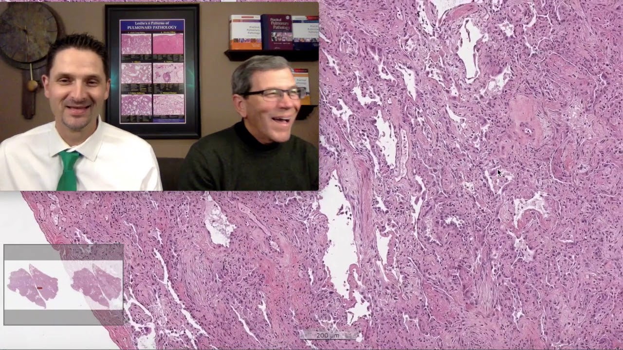 Pattern 1 – Acute Lung Injury, Amiodarone Induced DAD (Top 25 Pearls Series, Topic 6, Pearl 4)