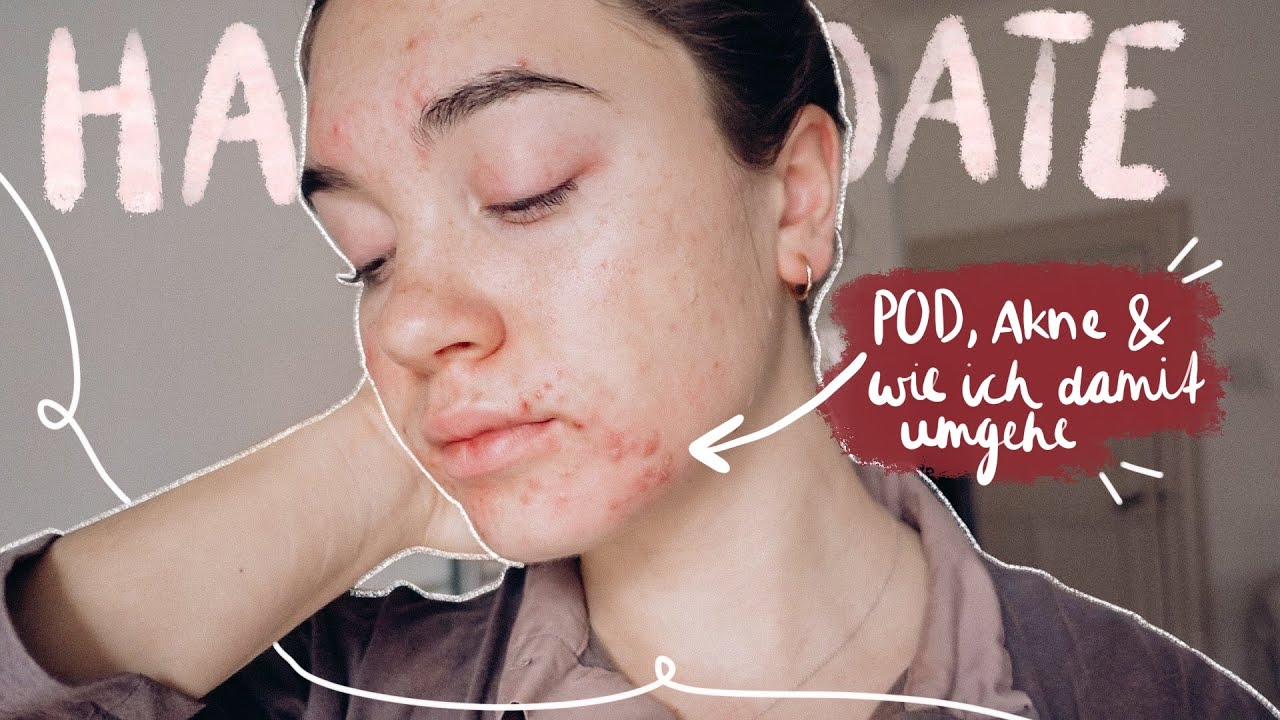 Periorale Dermatitis, Akne und wie ich damit umgehe - Hautupdate