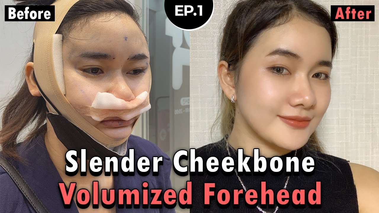 [SUB] Quick Cheekbone Reduction & Facial Fat Grafting Surgery in Korea | Reduction Malarplasty Vlog