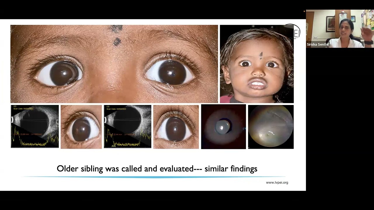 Optimising genetic testing in pediatrics glaucoma clinic//Biallelic LTBP2 causing defined phenotypes