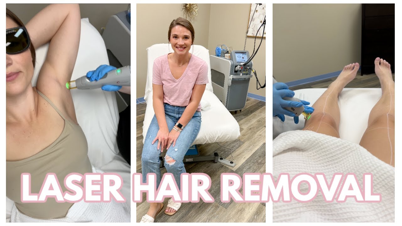MY EXPERIENCE WITH LASER HAIR REMOVAL AT MILAN | BRAZILIAN, LEGS, AND UNDERARMS LASER HAIR REMOVAL