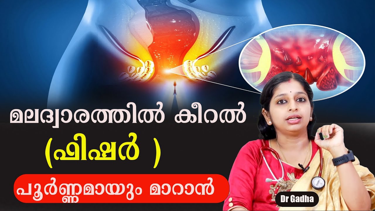 ഫിഷർ  പൂർണ്ണമായും മാറാൻ /Dr Gadha