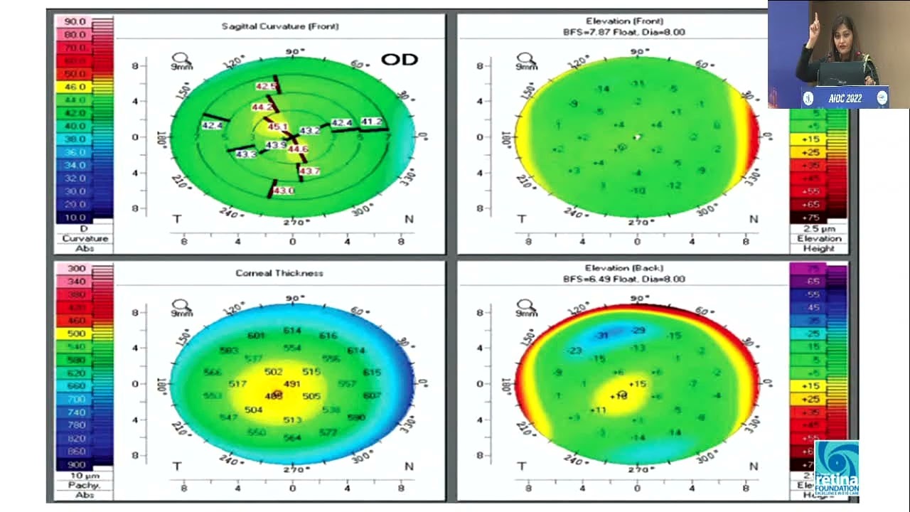 AIOC2022 - IC189 - Refractive surgery toolbox: What all do we need to become suc...Dr Sheetal Brar