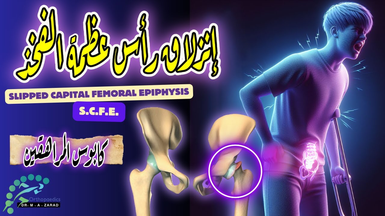 Соскользнувший эпифиз головки бедренной кости | СКЭФ | Весь эпизод