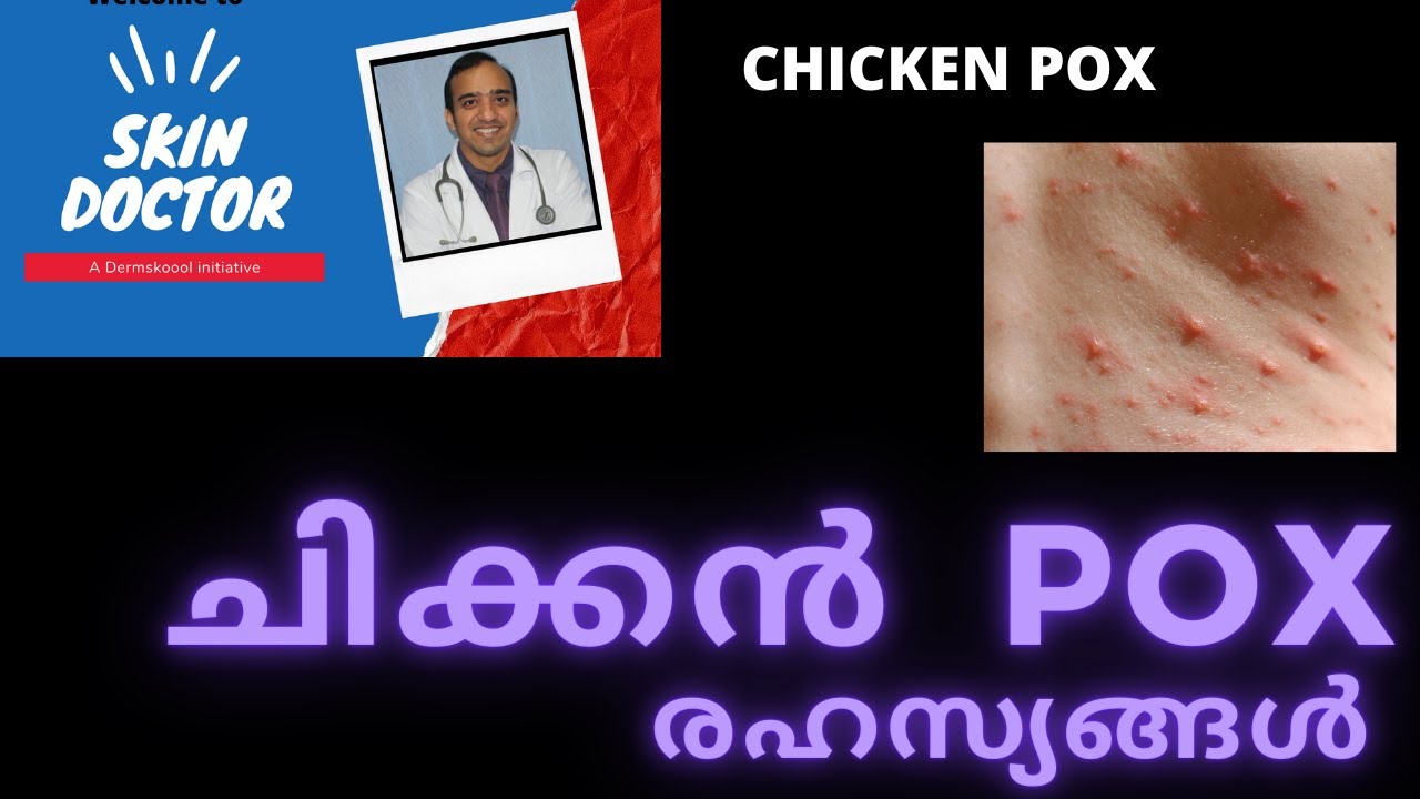 Chicken pox malayalam/ chicken pox complications malayalam /Dr.Sujithkumar