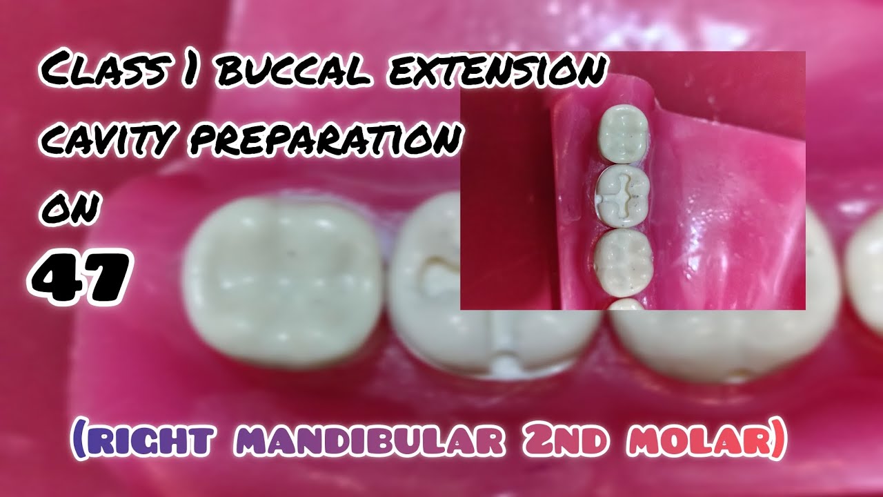 Class 1 buccal extension cavity preparation on 47 (right mandibular 2nd molar)